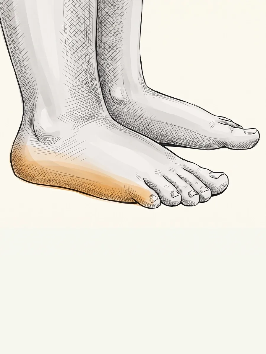 Illustration of a child's foot with a flattened, collapsed arch