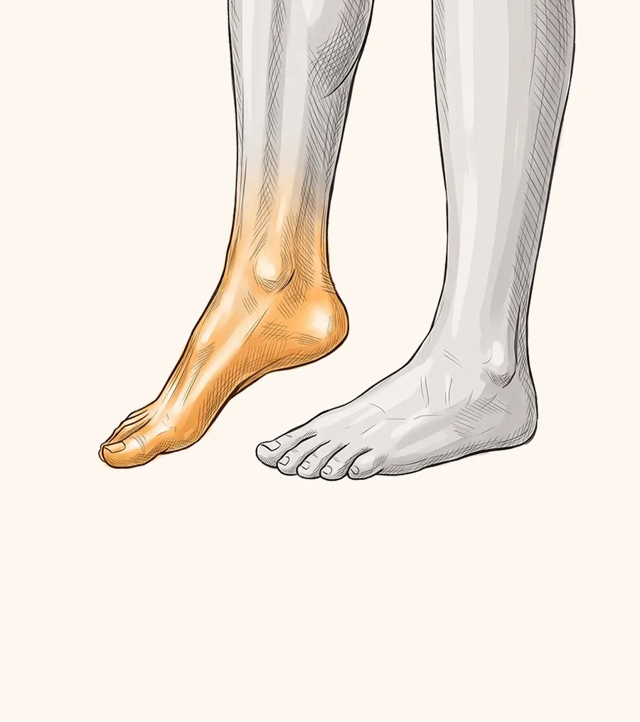 Illustration of a foot dragging due to foot drop