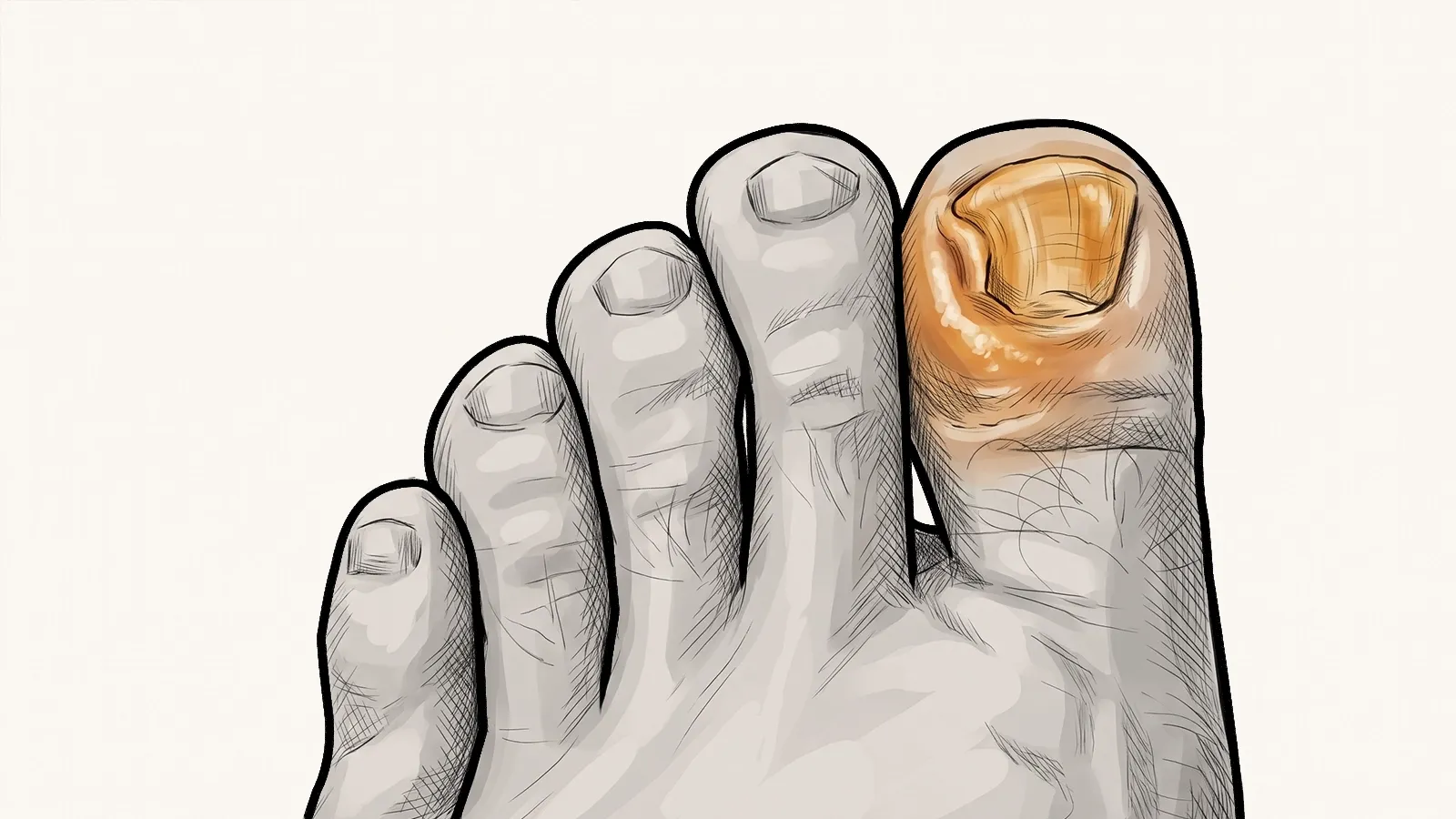 Illustration of a clinician examining toes with thickened, discoloured toenails